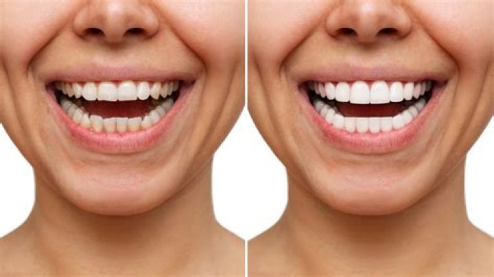 Matt Rife's Teeth Veneers: Unlocking A Radiant Smile